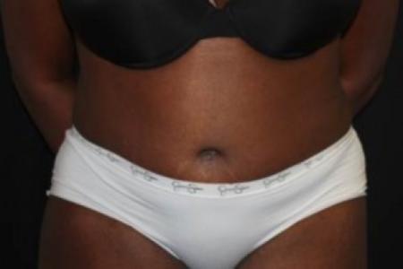 After image 1 Case #84586 - Abdominoplasty - 51 year old female