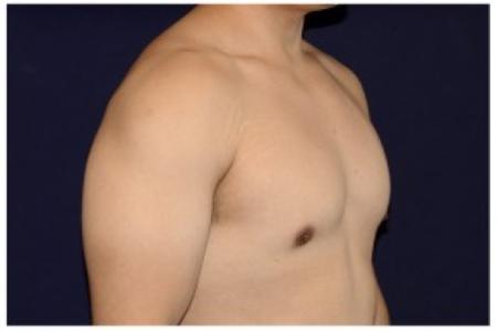 After image 2 Case #82176 - Gynecomastia