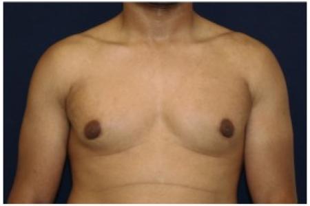 After image 1 Case #82076 - Gynecomastia