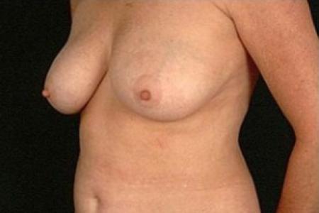 After image 2 Case #81486 - Breast Reduction