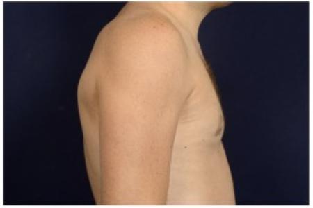After image 3 Case #86916 - Gynecomastia