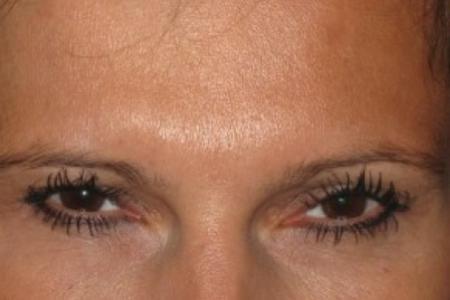 After image 1 Case #82626 - Botox - glabella