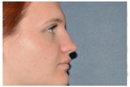 After image 1 Case #87101 - Non-Surgical Rhinoplasty