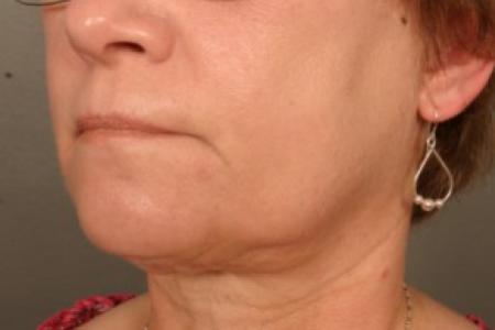 After image 2 Case #83581 - Neck Liposuction