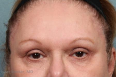 After image 1 Case #88181 - Upper and Lower Eyelid Lift with Lateral Brow Lift