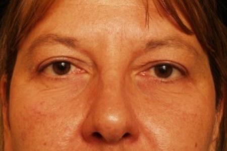 After image 1 Case #81741 - Eyelid Surgery