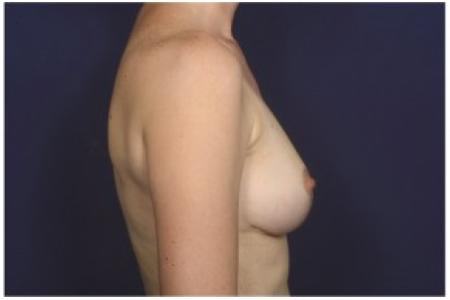 After image 3 Case #84616 - 35-44 year old woman treated with Breast Reduction