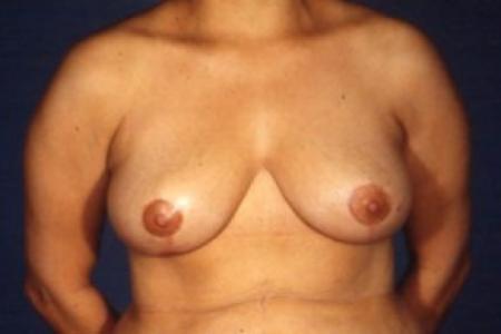 After image 1 Case #81451 - Breast Reduction/Lift