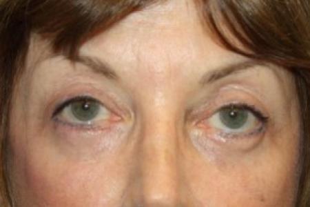 After image 1 Case #84711 - Blepharoplasty - 59 year old female.