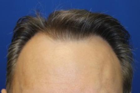 After Case #87391 - Hair Transplantation San Diego