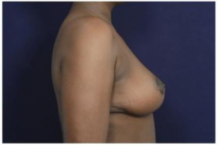 After image 3 Case #84601 - 35-44 year old woman treated with Breast Reduction