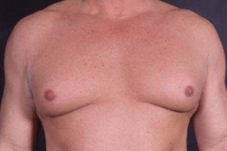 After image 1 Case #85246 - Bilateral Nipple Reduction