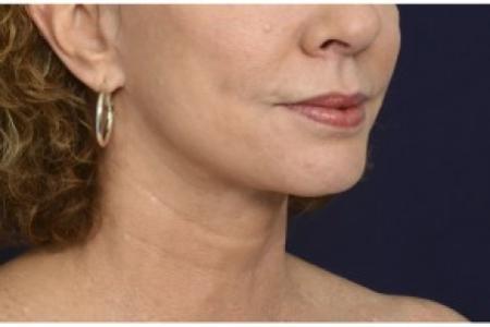 After image 2 Case #86401 - 50 year old woman treated with lower facial rejuvenation