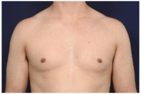 After image 1 Case #86211 - 32 year old man treated with Male Breast Reduction