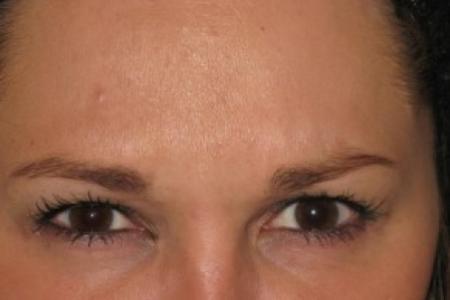After image 1 Case #82636 - Botox - Glabella 