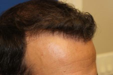 After Case #87396 - Hair Transplantation San Diego