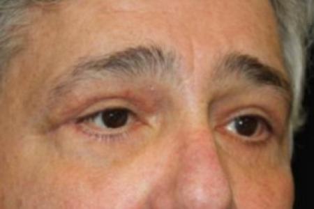 After image 2 Case #84216 - Blepharoplasty - 61 year old male
