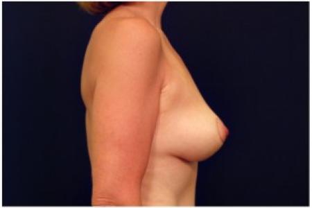 After image 3 Case #82056 - Breast Lift
