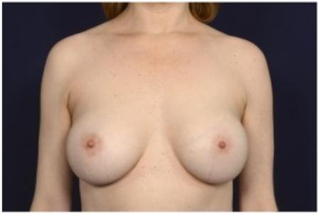 After image 1 Case #86236 - 39 year old woman treated with Breast Augmentation