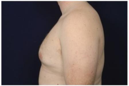 After image 3 Case #85611 - Gynecomastia