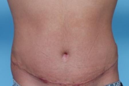 After image 1 Case #82221 - Male Liposuction