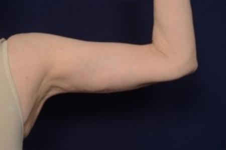 After image 1 Case #87461 - Upper Arm Lift
