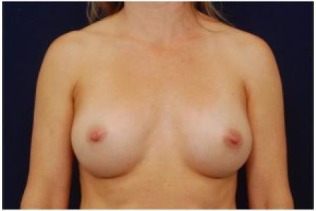After image 1 Case #82006 - Breast Augmentation