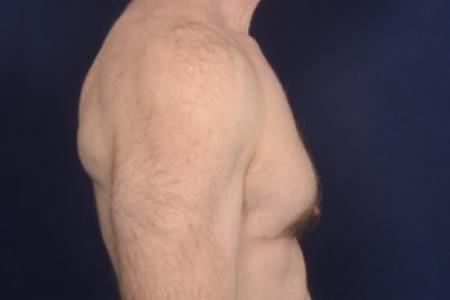 After image 3 Case #87516 - Gynecomastia