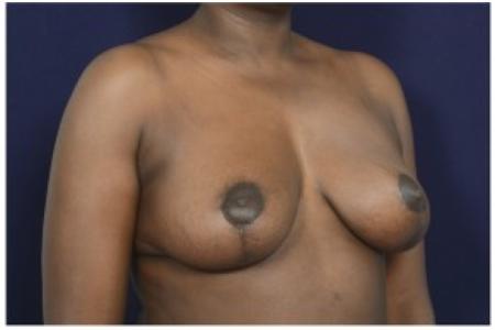 After image 2 Case #84601 - 35-44 year old woman treated with Breast Reduction