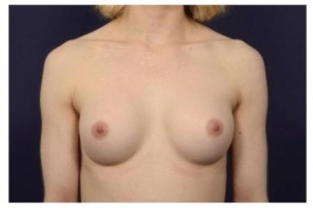 After image 1 Case #87026 - Breast Augmentation