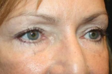 After image 2 Case #83456 - Blepharoplasty - 57 year old female.