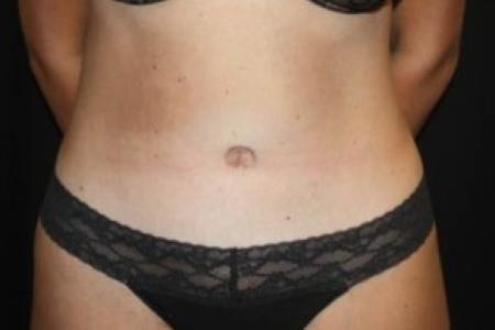 After image 1 Case #84621 - Abdominoplasty - 35 year old female