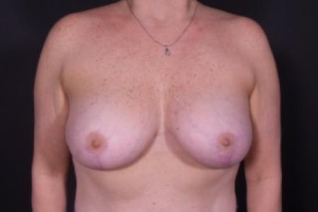 After image 1 Case #85316 - Bilateral Vertical Breast Lift