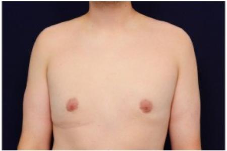 After image 1 Case #82071 - Gynecomastia