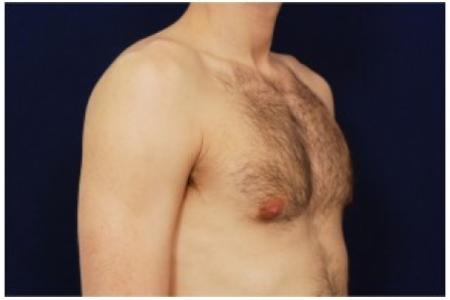 After image 2 Case #82161 - Gynecomastia
