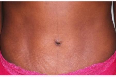 After image 1 Case #86971 - Tummy Tuck