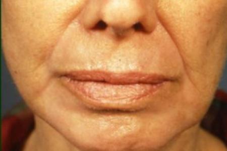 After Case #81591 - Chemical Peel / Facelift