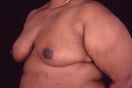 After image 2 Case #81461 - Breast Reduction/Lift