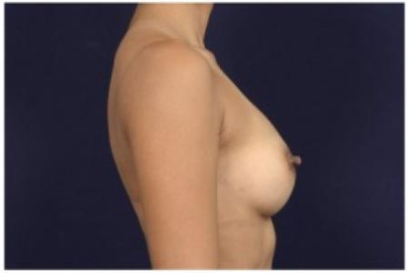 After image 3 Case #86891 - Breast Augmentation