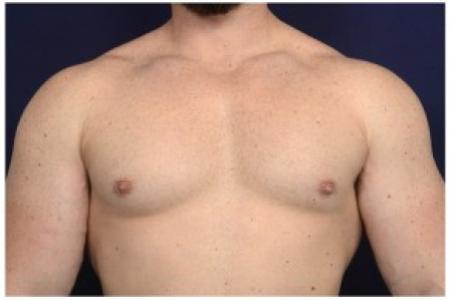 After image 1 Case #86196 - 32 year old man treated with Male Breast Reduction