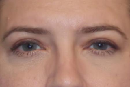 After image 1 Case #88331 - Upper Eyelid Lift