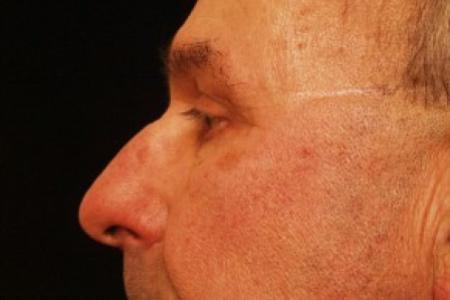 After image 2 Case #81731 - Eyelid Surgery