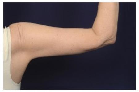 After image 2 Case #86996 - Upper Arm Lift