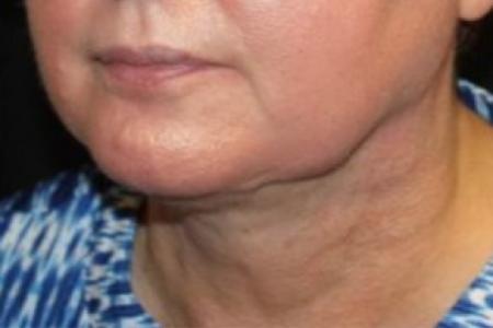 After image 2 Case #84816 - Liposuction Submental - 52 year old female.