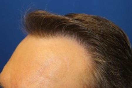 After Case #87391 - Hair Transplantation San Diego