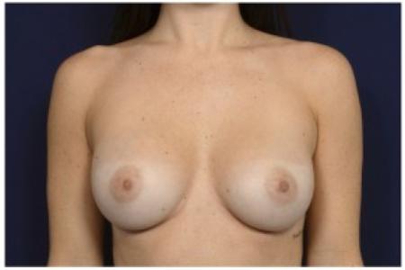 After image 1 Case #86886 - Breast Augmentation