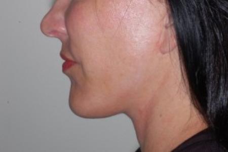 After image 2 Case #87216 - Chin Implant