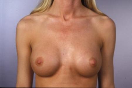 After image 1 Case #83256 - Breast Augmentation with Saline Implants