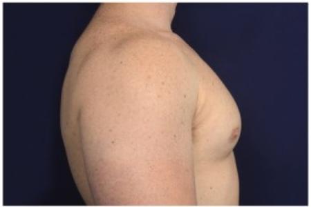 After image 3 Case #86196 - 32 year old man treated with Male Breast Reduction