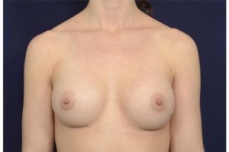 After image 1 Case #86871 - Breast Augmentation
